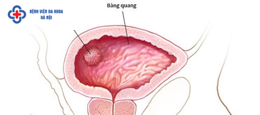 Thiết bị y tế trong bàng quang gây sỏi 