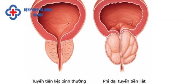 Tuyến tiền liệt u phì tạo áp lực lên bàng quang 